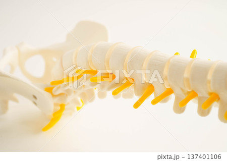 Spinal nerve and bone, Lumbar spine displaced herniated disc fragment, Model for treatment medical in the orthopedic department. Spinal nerve and bone, Lumbar spine displaced herniated disc fragment, Model for treatment medical in the orthopedic department. 137401106