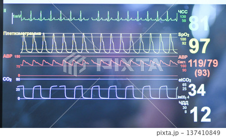 Vital signs display on medical monitor showing ECG, SpO2, and blood pressure waves 137410849