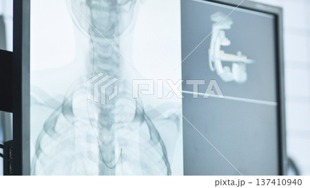 Medical imaging display showing human chest x-ray with an inserted catheter wire 137410940
