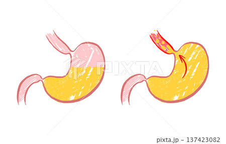 Gastroesophageal reflux pain 137423082