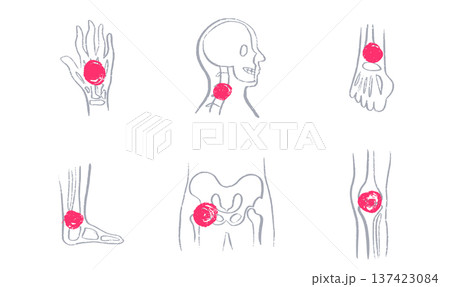 Arthritis Sketch Poster Arthritis Sketch Poster 137423084