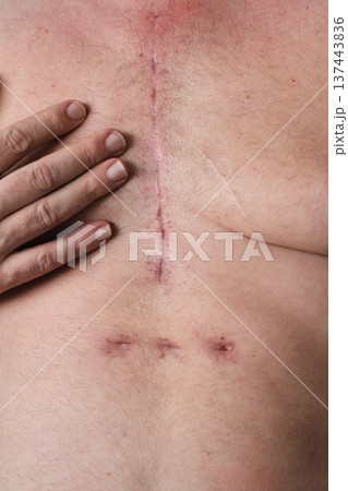 scar on a man's chest after heart surgery scar on a man's chest after heart surgery 137443836