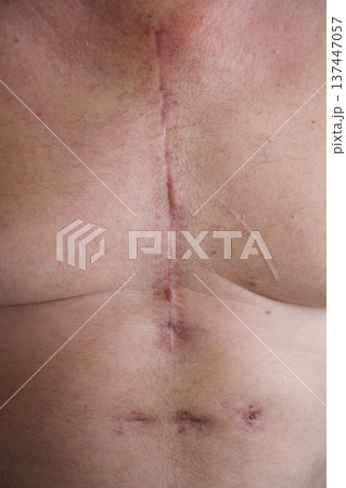 scar on a man's chest after heart surgery 137447057