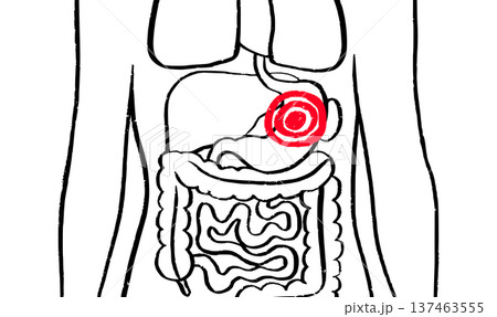 Gastroesophageal reflux pain 137463555