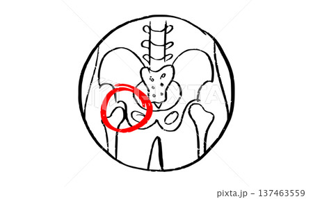 Osteomyelitis disease sketch Osteomyelitis disease sketch 137463559