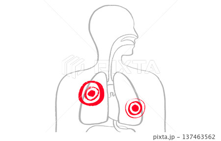 Lung disease concept 137463562