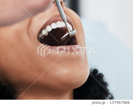Mouth, teeth of woman and dentist with tools for dental cosmetics, healthcare assessment and test in clinic. Oral service, orthodontics and closeup of patient, mirror and excavator for tooth cleaning Mouth, teeth of woman and dentist with tools for dental cosmetics, healthcare assessment and test in clinic. Oral service, orthodontics and closeup of patient, mirror and excavator for tooth cleaning 137467866