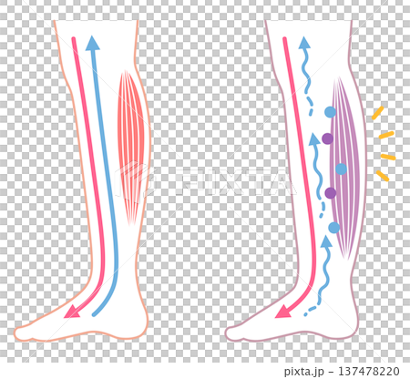 腿部腫脹：水腫的成因 137478220