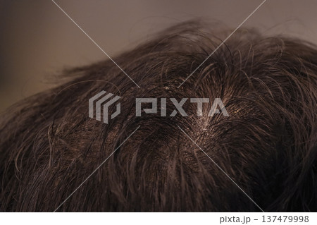 頭頂部の薄毛と頭皮の状態 頭頂部の薄毛と頭皮の状態 137479998