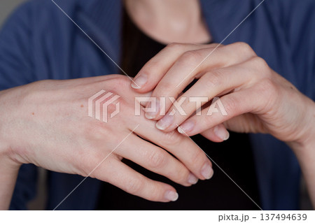 Damaged natural nails after gel polish removal on female hands 137494639