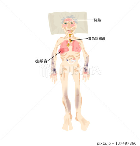 肺炎の全身所見イラスト|寝たきり高齢患者の状態が一目でわかる医療ビジュアル 肺炎の全身所見イラスト|寝たきり高齢患者の状態が一目でわかる医療ビジュアル 137497860