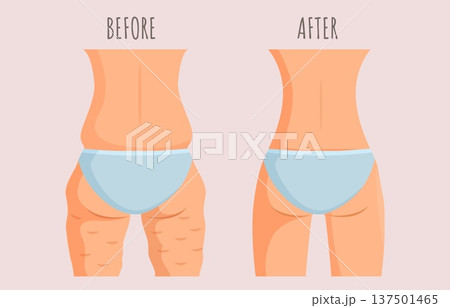 Girl with and without cellulite. Fat slim female butt, legs and back. Body before and after fitness training, diet, healthy nutrition results, sapid vector concept Girl with and without cellulite. Fat slim female butt, legs and back. Body before and after fitness training, diet, healthy nutrition results, sapid vector concept 137501465