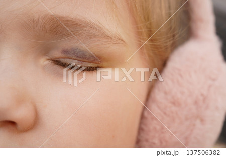 Girl with bruise on eye wearing pink ear muffs during winter 137506382