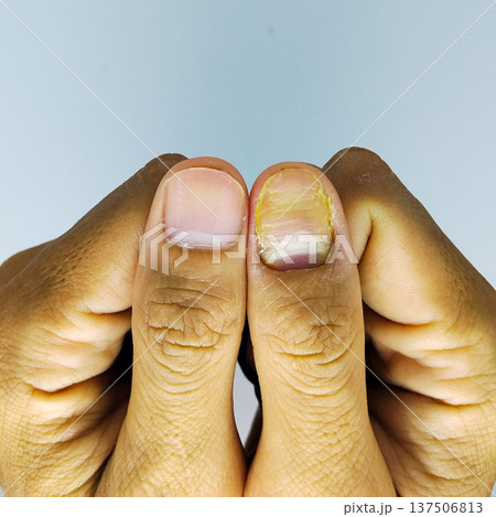Close up of a nail fungus on a white background 137506813
