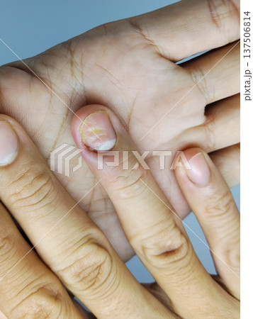 swollen and pus-filled hands due to ingrown toenails 137506814