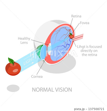 3D Isometric Flat Vector Illustration of Vision Disorder, Far-Sightedness And Near-Sightedness Anatomical Diagram. Item 3 3D Isometric Flat Vector Illustration of Vision Disorder, Far-Sightedness And Near-Sightedness Anatomical Diagram. Item 3 137508721