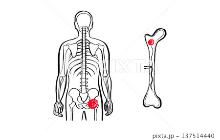 Osteomyelitis disease sketch Osteomyelitis disease sketch 137514440