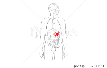Gastroesophageal reflux pain Gastroesophageal reflux pain 137514451