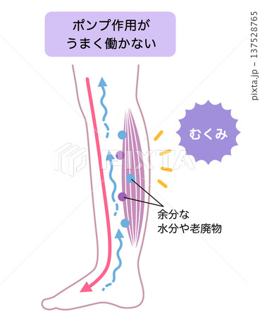 脚のむくみ 浮腫のしくみ 脚のむくみ 浮腫のしくみ 137528765