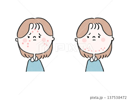 思春期ニキビに悩む女性と大人ニキビに悩む女性（吹き出物の部位の比較） 137538472