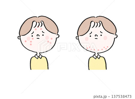 思春期ニキビに悩む男性と大人ニキビに悩む男性(吹き出物の部位の比較) 思春期ニキビに悩む男性と大人ニキビに悩む男性(吹き出物の部位の比較) 137538473