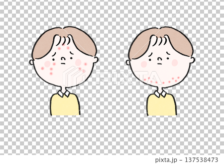 思春期ニキビに悩む男性と大人ニキビに悩む男性(吹き出物の部位の比較) 思春期ニキビに悩む男性と大人ニキビに悩む男性(吹き出物の部位の比較) 137538473