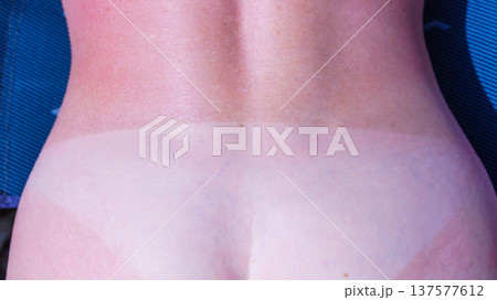 Woman body after taking off bikini with visible tan line from wearing panties 137577612