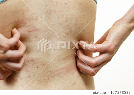 Woman scratching her itchy back with allergy rash 137578582