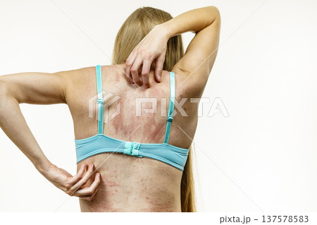 Woman scratching her itchy back with allergy rash Woman scratching her itchy back with allergy rash 137578583