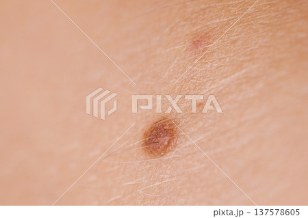 Closeup brown mole on caucasian woman skin. 137578605