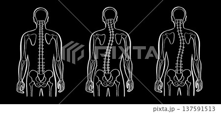 Scoliosis spine deformity 137591513
