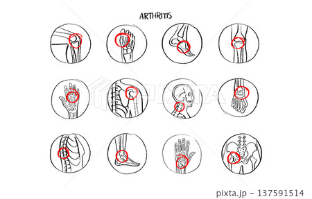 Arthritis Sketch Poster 137591514