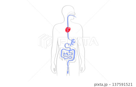 Esophagus pain diagram Esophagus pain diagram 137591521