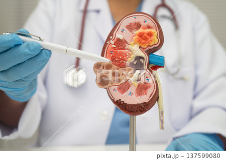 Chronic kidney disease, doctor with model for treatment urinary system, urology, Estimated glomerular filtration rate eGFR. Chronic kidney disease, doctor with model for treatment urinary system, urology, Estimated glomerular filtration rate eGFR. 137599080