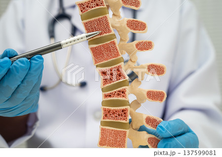 Doctor holding osteoporosis in back bone model. Doctor holding osteoporosis in back bone model. 137599081