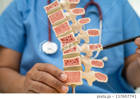 Doctor holding osteoporosis in back bone model for treatment medical in orthopedic department. Doctor holding osteoporosis in back bone model for treatment medical in orthopedic department. 137607741