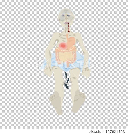 Illustration of symptoms of upper gastrointestinal bleeding: vomiting blood, black stools, pale complexion, medical education chart 137621568