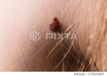 Closeup brown mole on caucasian woman skin. 137623647