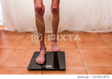 Woman with anorexia standing on bathroom scale Woman with anorexia standing on bathroom scale 137631973