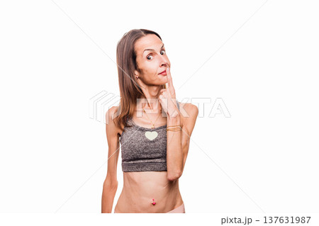 Woman with anorexia pointing at her face with concern Woman with anorexia pointing at her face with concern 137631987