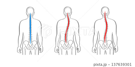 Scoliosis spine deformity 137639301
