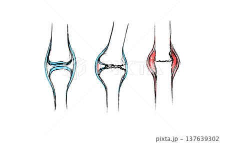 Arthritis Sketch Poster 137639302