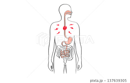 Esophagus pain diagram Esophagus pain diagram 137639305