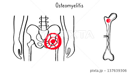 Osteomyelitis disease sketch 137639306