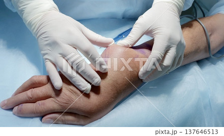Russia Tomsk 05.07.2025: Assistant stabilizing hand during prep for foot and ankle procedure, gloved hands holding limb steady while vascular lines lie nearby, calm surgical environment Russia Tomsk 05.07.2025: Assistant stabilizing hand during prep for foot and ankle procedure, gloved hands holding limb steady while vascular lines lie nearby, calm surgical environment 137646513