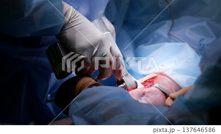 Surgical team performing complex medical intervention, using specialized equipment while maintaining focused collaboration during delicate healthcare procedure Surgical team performing complex medical intervention, using specialized equipment while maintaining focused collaboration during delicate healthcare procedure 137646586