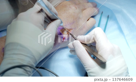 Russia Tomsk 05.07.2025: Electrocautery tool dissecting tissue during hand surgery with visible plume and suction; team controlling bleeding, thermal coagulation, device settings adjusted 137646609