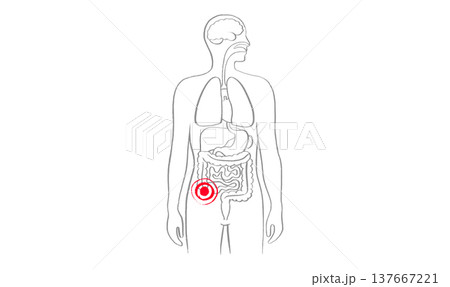 Inflamed appendix scetch 137667221