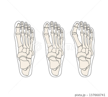 Human foot skeleton anatomy showing hallux valgus bunion progression, medical orthopedic diagram set Human foot skeleton anatomy showing hallux valgus bunion progression, medical orthopedic diagram set 137668741