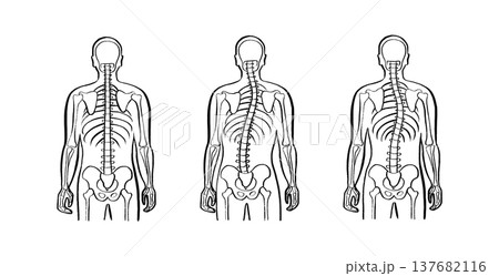 Scoliosis spine deformity 137682116